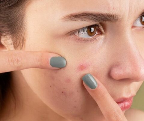 Mujer apuntando a un grano que tiene en el rostro, acne